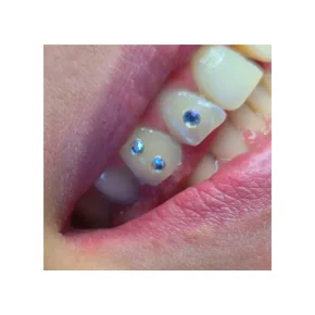 Strass dentaire petit-mars